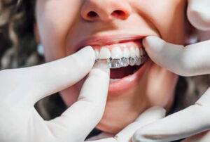 Woman getting Invisalign in Singapore